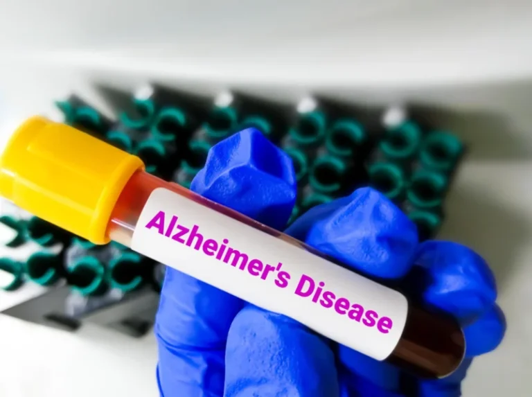 Gloved hand holding a blood sample tube labelled Alzheimer's Disease