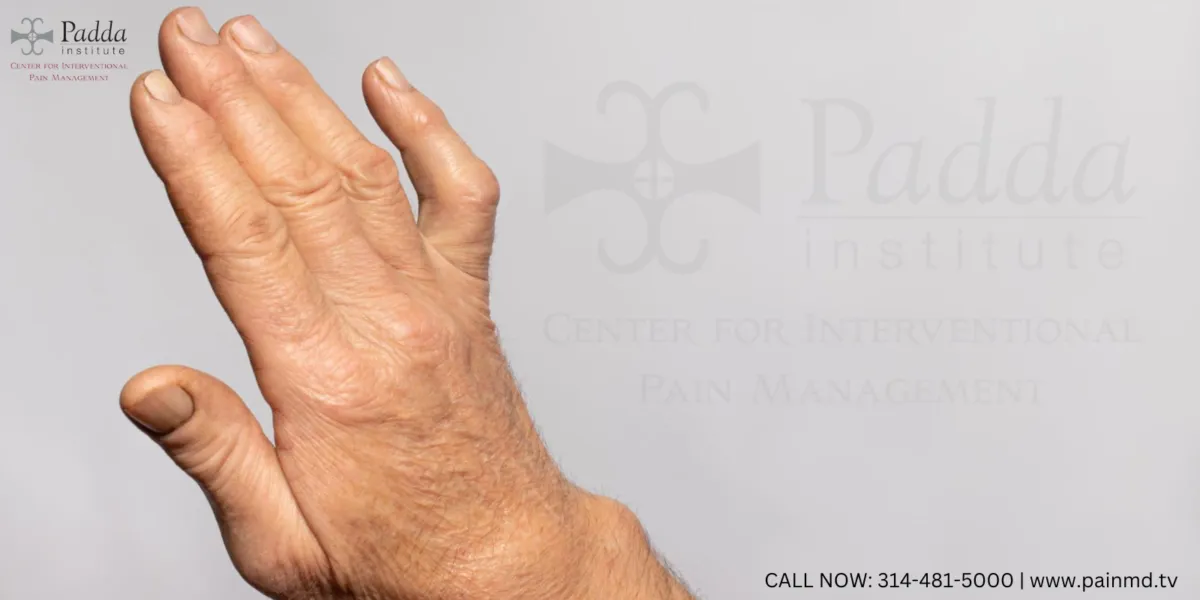 LIPOFILLING PROVIDES LONG-LASTING RELIEF IN FINGER OSTEOARTHRITIS