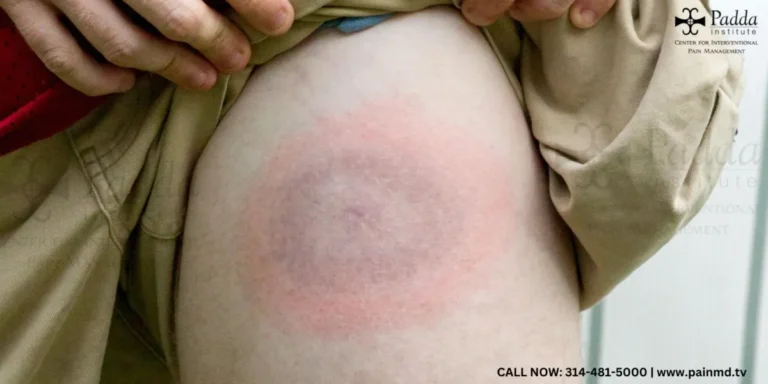Circular bullseye rash on the skin from a tick bite