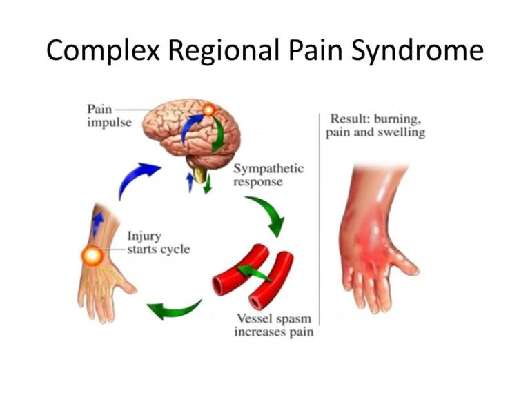 Causes of Complex Regional Pain Syndrome - Padda Institute
