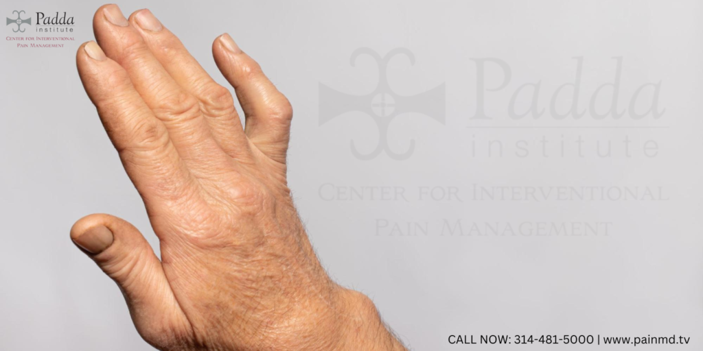 Lipofilling Provides Long-Lasting Relief in Finger Osteoarthritis