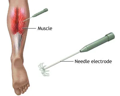 Electrode Needles - Electrodiagnostics Testing
