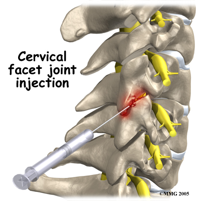 Cervical Facet Joint Injection - Padda Institute