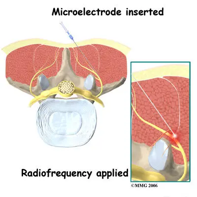 Facet Joint Radiofrequency Ablation Procedure