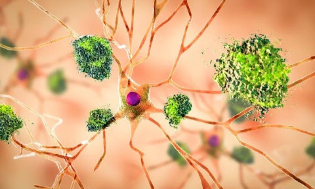 Altered cholesterol metabolism in the brain may have a role in Alzheimer’s