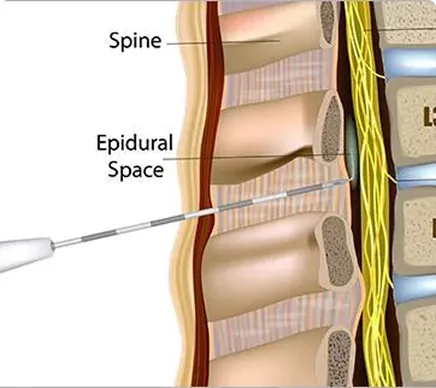 Epidural Steroid Injection (ESI)