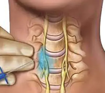 Stellate Ganglion Block