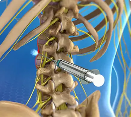 Lumbar Sympathetic Nerve Block