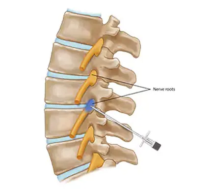 Selective Nerve Root Block