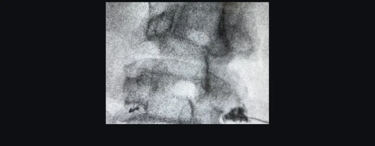 Fluoroscopic image of the lumbar spine showing epidural contrast spread at L4-5 and L5-S1 at Padda Institute, St. Louis