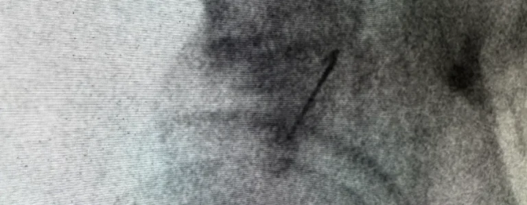 Fluoroscopic image of the piriformis region with extensive scarring, a common source of sciatica-type pain, at Padda Institute, St. Louis