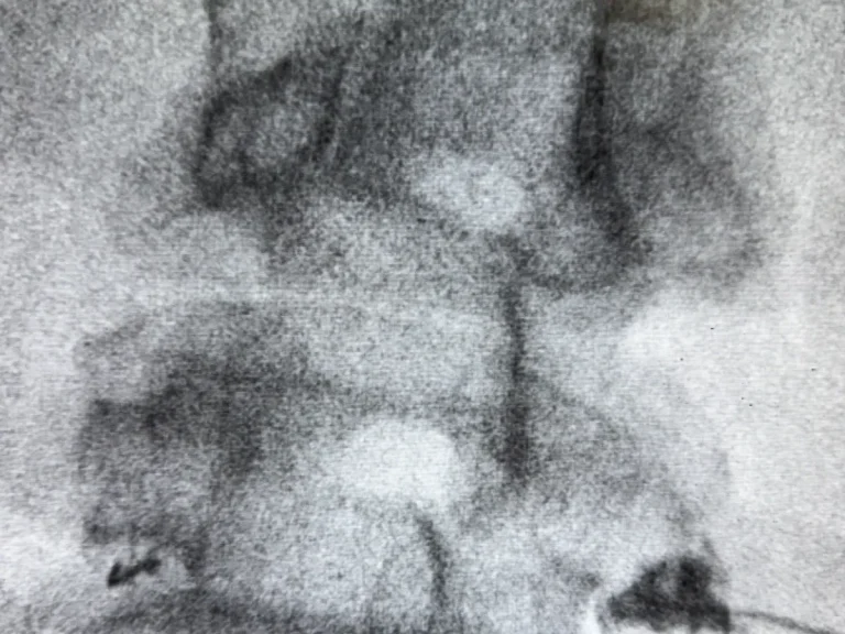 Fluoroscopic view of the lumbar spine dorsal root ganglion targeted during neurostimulation
