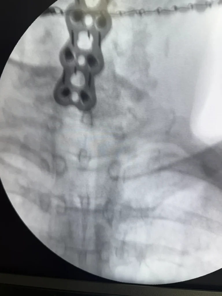 Fluoroscopic image of anterior plates and two intradiscal spacers in a failed back surgery patient