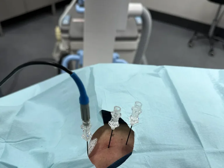 Cervical radiofrequency treatment underway in the image-guided procedure suite