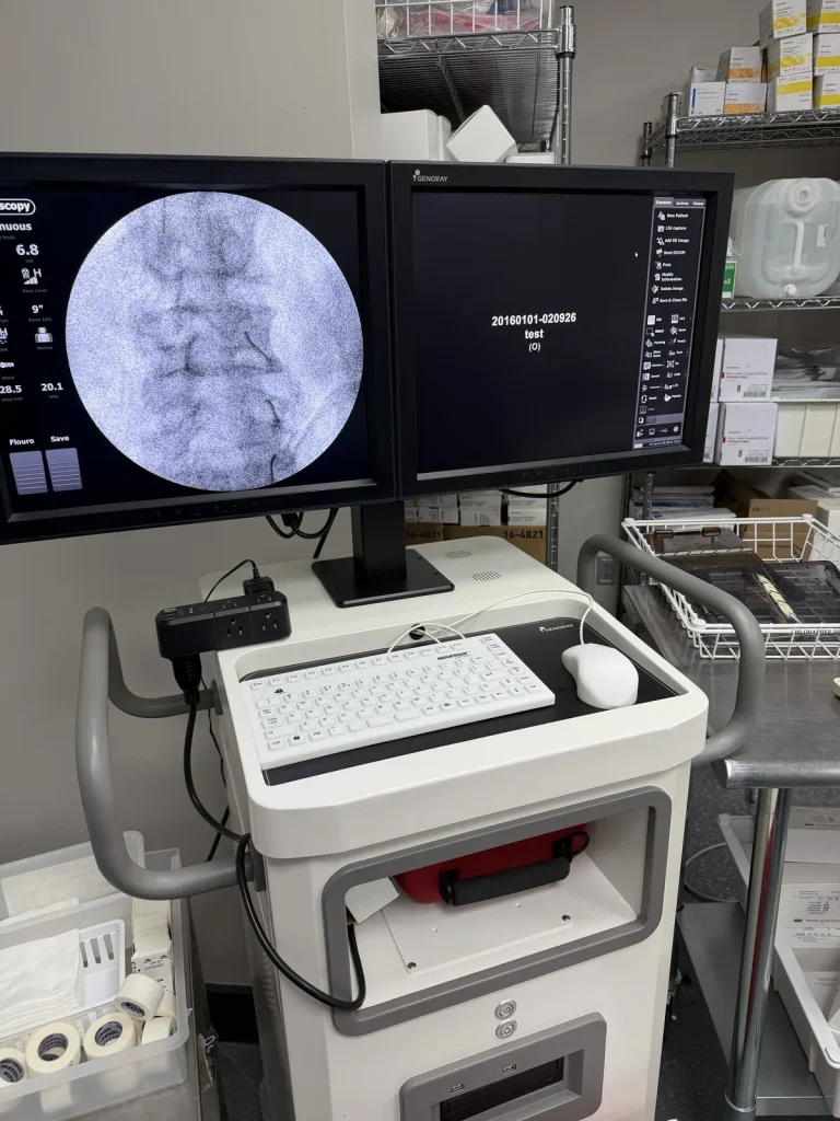 Fluoroscopic image of a medial branch nerve block with contrast outlining the target