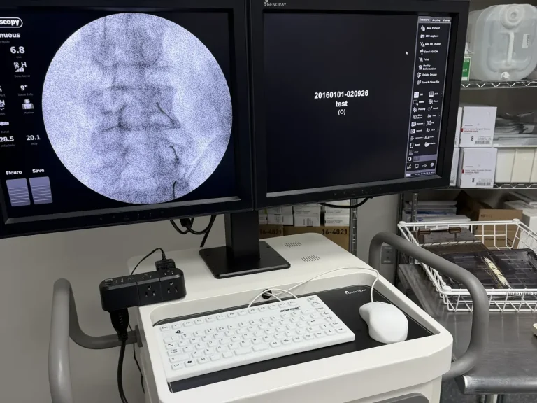 Fluoroscopic image of a medial branch nerve block with contrast outlining the target