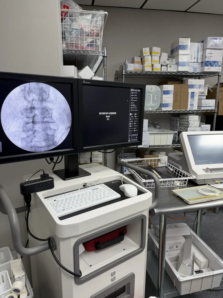 Fluoroscopic image of the lumbar spine during a guided sympathetic chain injection