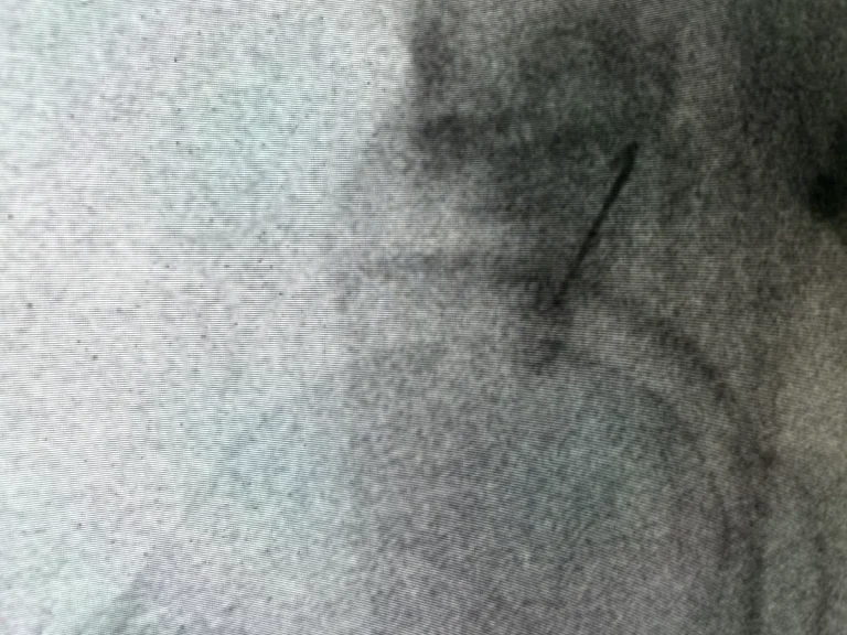 Piriformis Syndrome