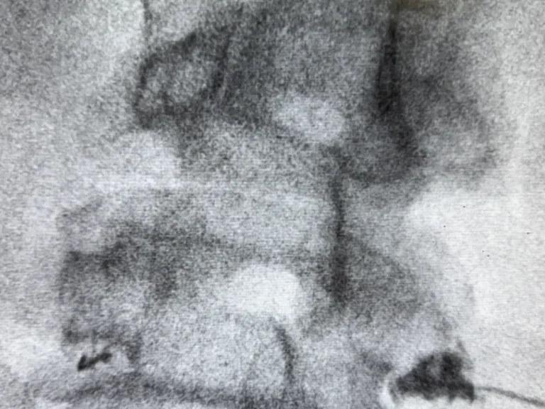 Fluoroscopic image of the lumbar spine showing epidural contrast spread at L4-5 and L5-S1 during an image-guided procedure at Padda Institute, St. Louis