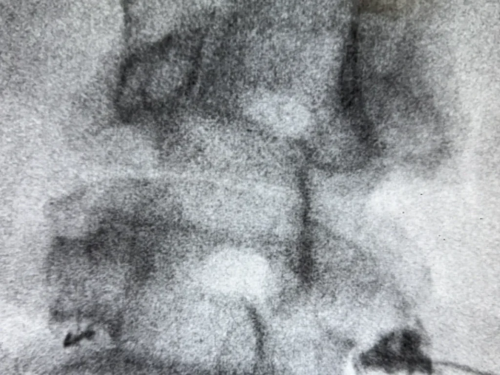 Fluoroscopic view of the lumbar spine dorsal root ganglion targeted during neurostimulation