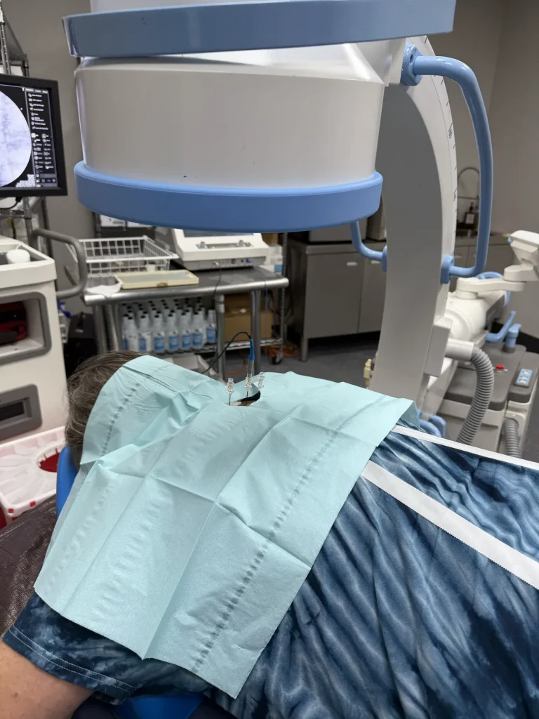 Needle positioning confirmed on live fluoroscopy before radiofrequency lesioning