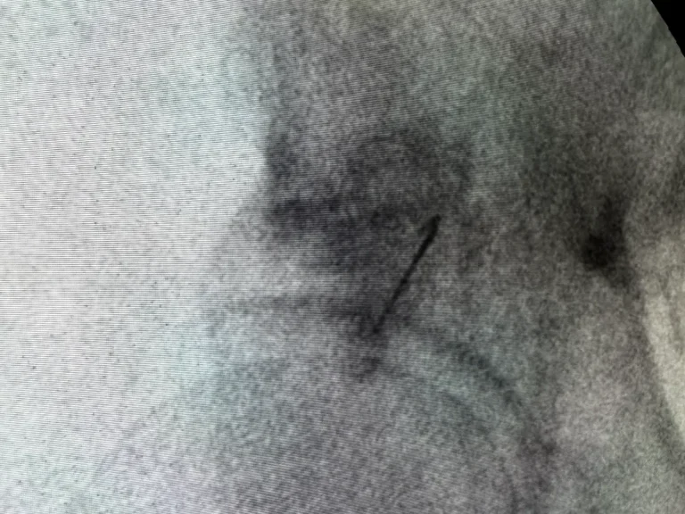 Fluoroscopic image of the piriformis region with extensive scarring, a common source of sciatica-type pain