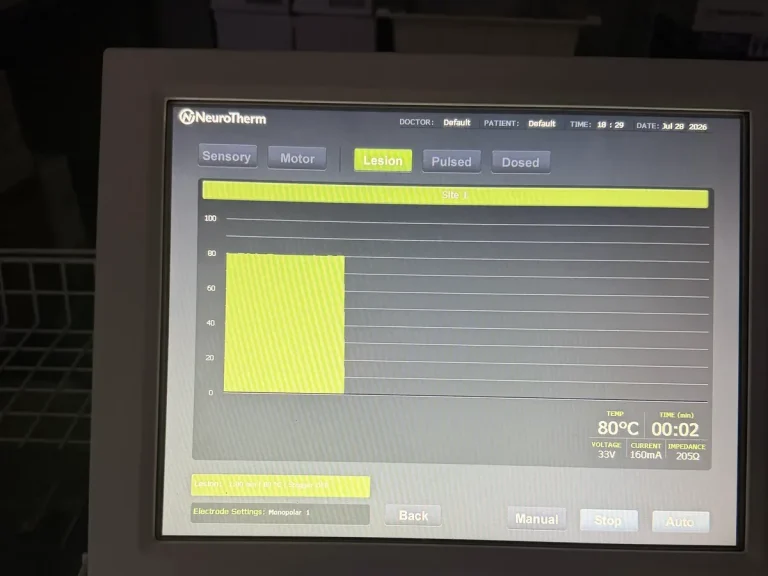 Radiofrequency generator showing an 80 degree Celsius lesion cycle during nerve ablation