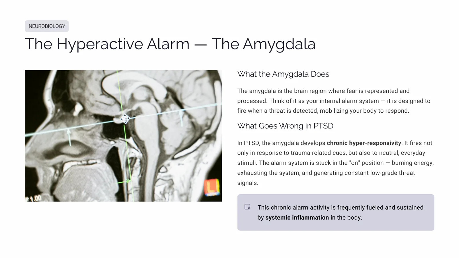 Slide describing the amygdala as an alarm system that becomes chronically hyper-responsive in PTSD