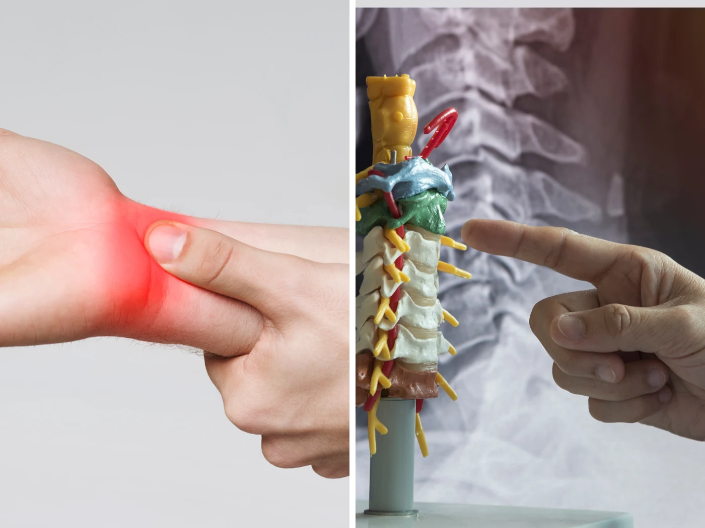 A hand held at the wrist with the median nerve region highlighted, beside a cervical spine model being indicated against a cervical radiograph