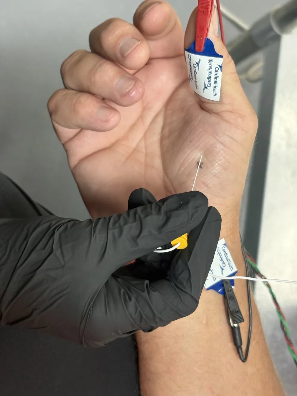 Stimulating probe held at the wrist crease with recording electrodes on the thumb and forearm during median nerve conduction testing at Padda Institute, St. Louis