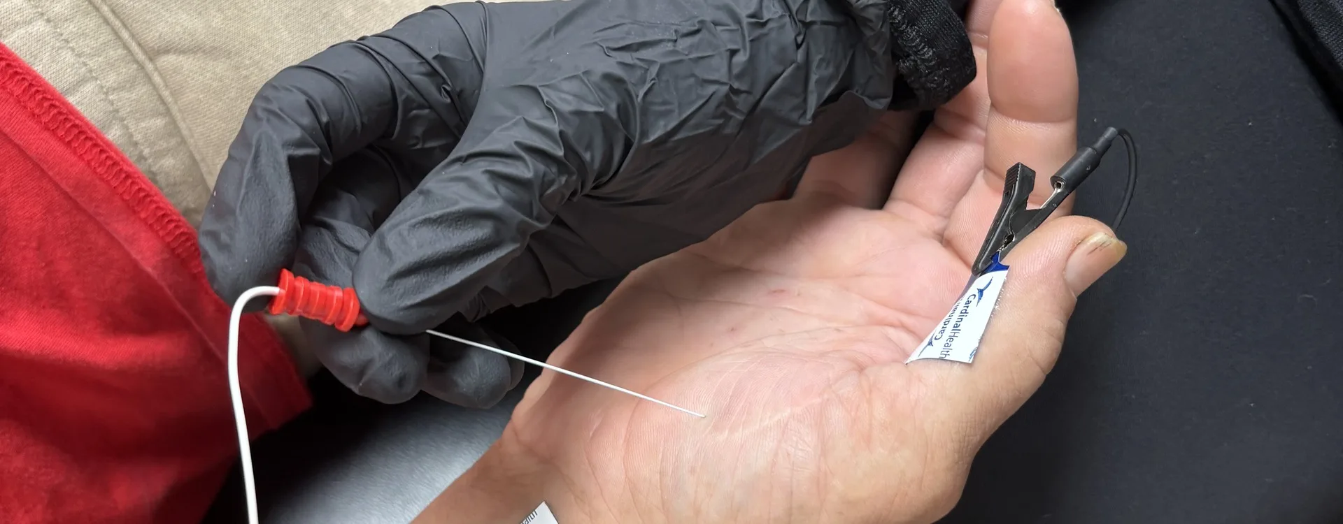 Gloved clinician holding the stimulating probe against a patient's palm with a recording electrode clipped to the finger during a nerve conduction study at Padda Institute, St. Louis