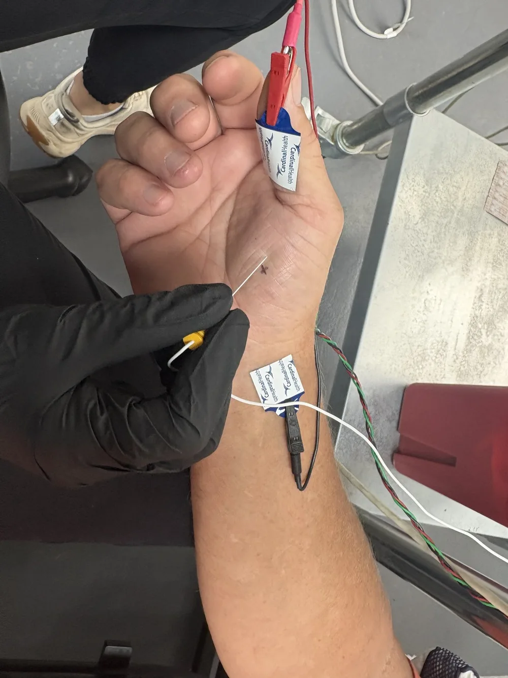 Median nerve stimulation at the wrist with recording electrodes on the thumb and forearm, the study used to separate carpal tunnel syndrome from cervical radiculopathy at Padda Institute, St. Louis