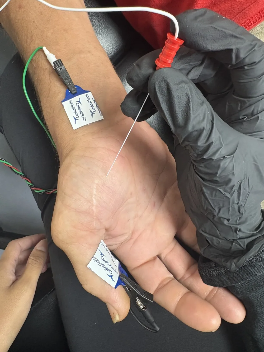 Close view of recording electrodes taped over the thenar eminence with a wrist reference electrode in place before median nerve stimulation at Padda Institute, St. Louis