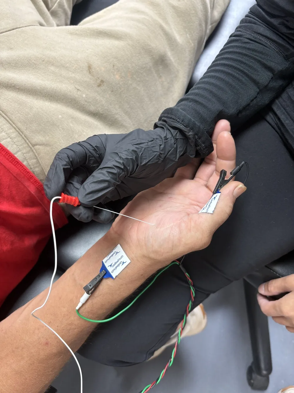 Gloved clinician holding a stimulating probe against the palm with surface recording electrodes taped to the hand and wrist during a nerve conduction study at Padda Institute, St. Louis