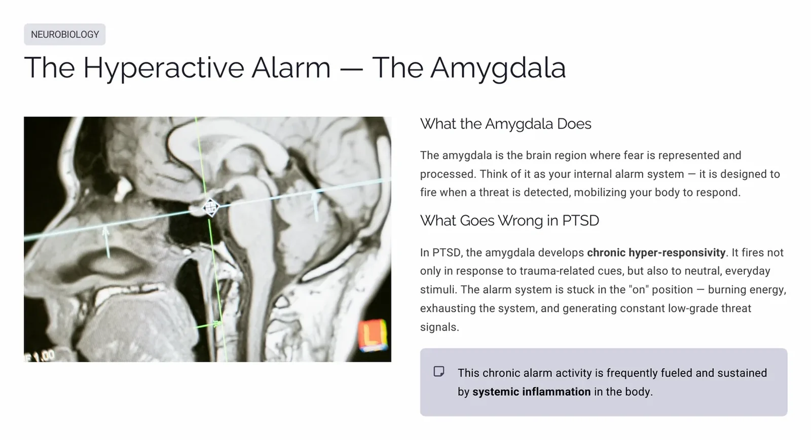 Slide describing the amygdala as an alarm system that becomes chronically hyper-responsive in PTSD