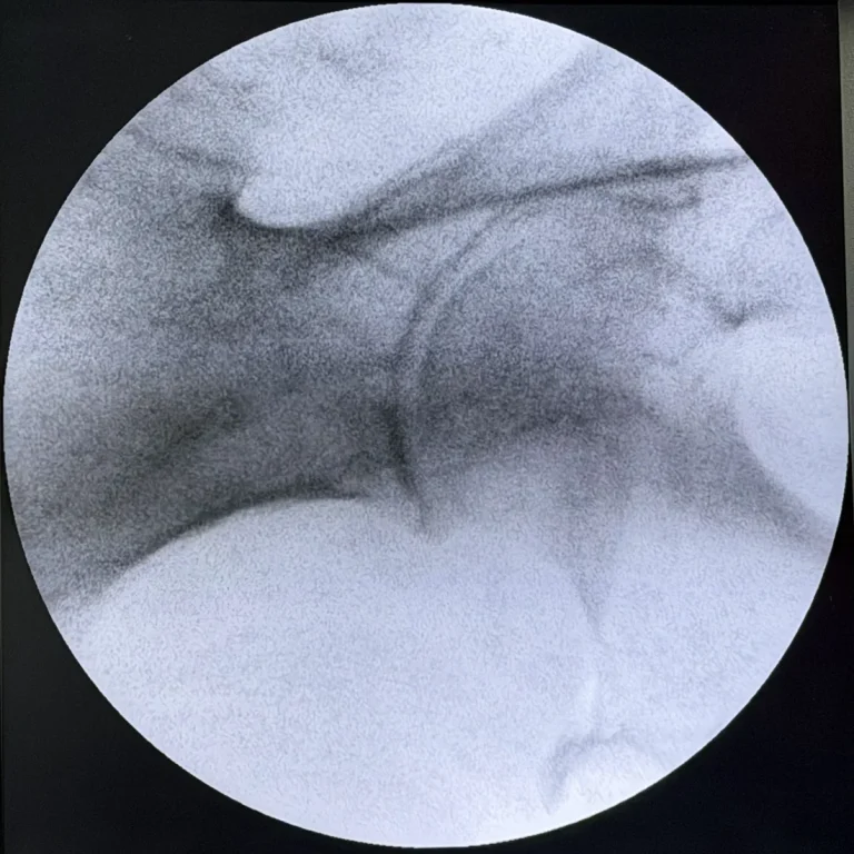 Fluoroscopy view of an arthritic left hip joint, one of the conditions that produces buttock and groin pain mistaken for piriformis syndrome, at Padda Institute in St. Louis, MO
