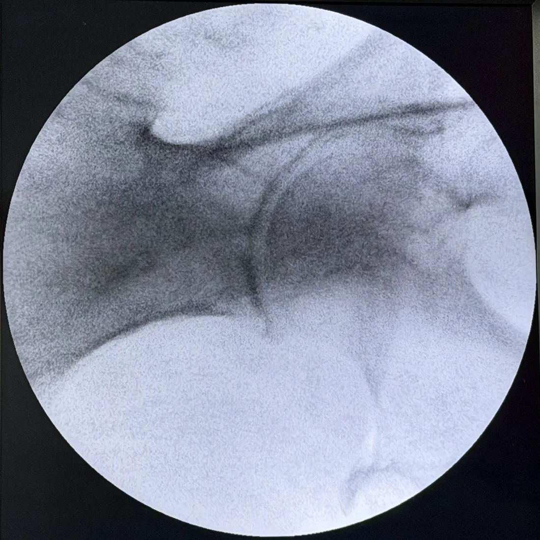 Baseline fluoroscopy view of the left hip before a piriformis injection at Padda Institute, 4477 Woodson Road, St. Louis, MO, with the C-arm dose readout on screen