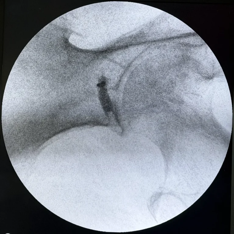 Fluoroscopic image showing Omnipaque 300 contrast outlining the left piriformis muscle belly, confirming needle placement before the injection is given, at Padda Institute, St. Louis, MO