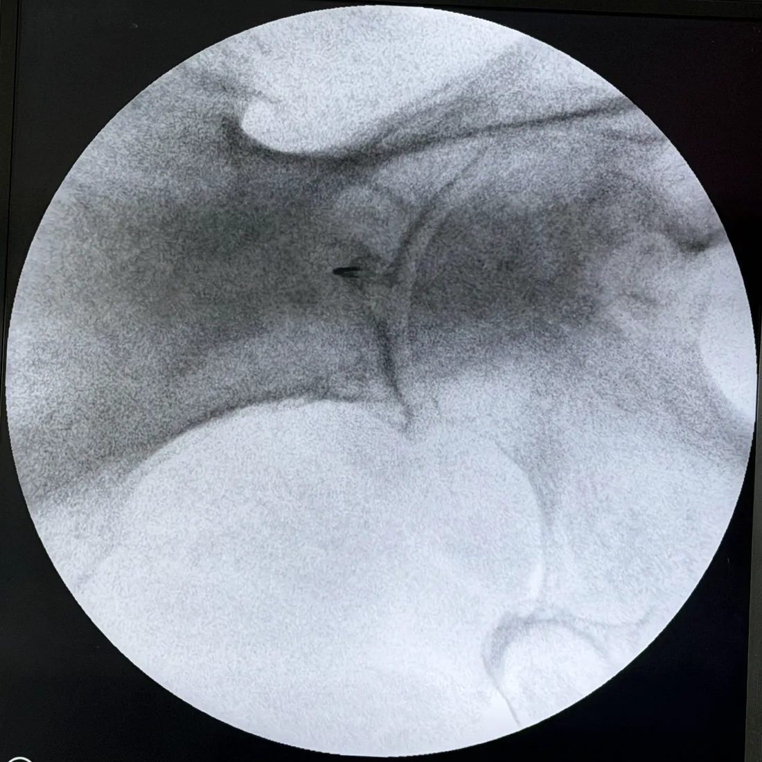 Fluoroscopic image showing the injection needle advancing toward the left piriformis muscle during an image-guided piriformis injection at Padda Institute, St. Louis, MO