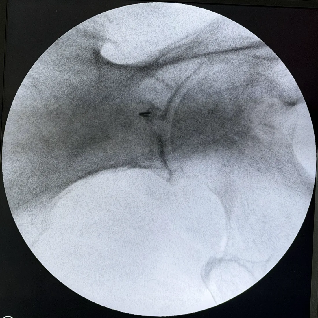 Close fluoroscopic view of the needle tip positioned within the left piriformis muscle before any injectate is delivered, at Padda Institute in St. Louis, MO