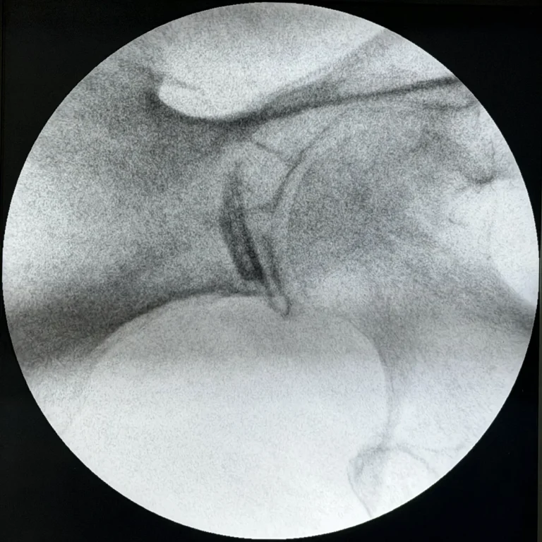 Fluoroscopic image taken after needle removal showing residual Omnipaque contrast still outlining the left piriformis muscle at the end of the injection, at Padda Institute, St. Louis, MO