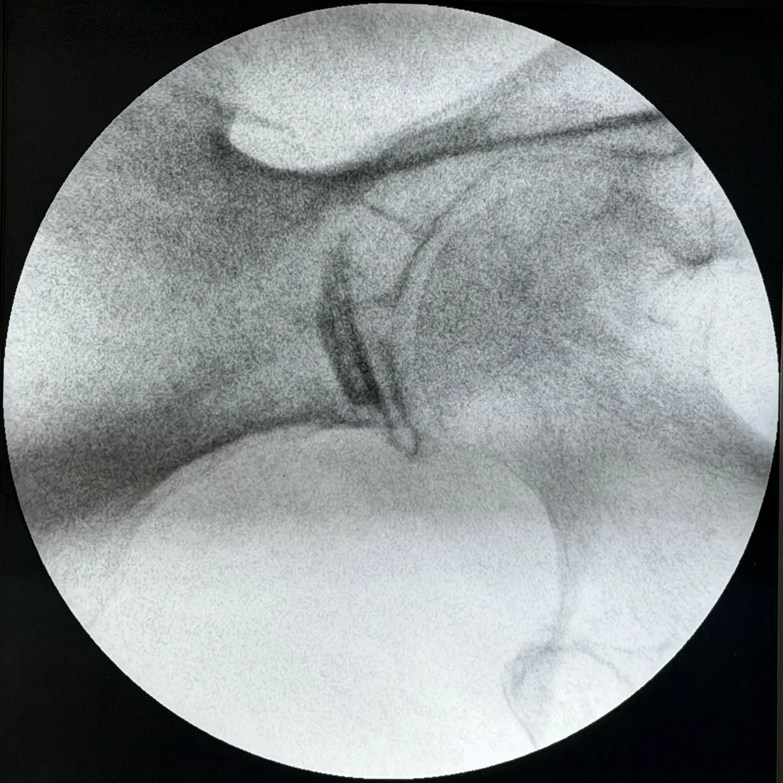 Fluoroscopic image taken after needle removal showing residual Omnipaque contrast still outlining the left piriformis muscle at the end of the injection, at Padda Institute, St. Louis, MO
