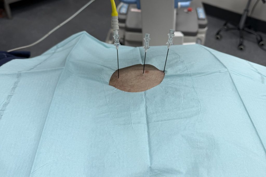 Radiofrequency neurolysis of the lumbar facet joints in progress: three insulated cannulae placed through the fenestration of a sterile drape, positioned under fluoroscopic guidance