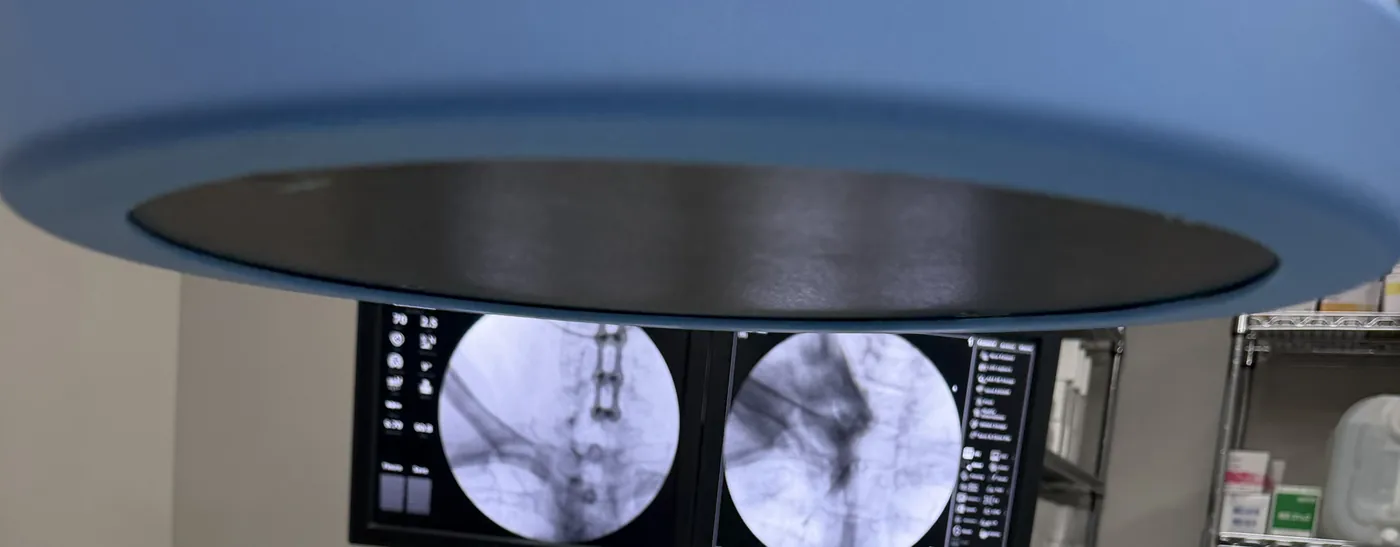 Fluoroscopy monitors under the C-arm in the procedure suite at Padda Institute, St. Louis