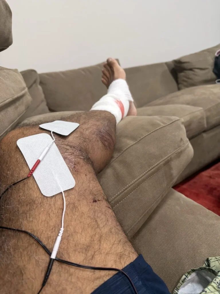 TENS electrode pads on a bruised knee, with the injured ankle bandaged in the background